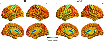 Decreased Intrinsic Neural Timescales in Mesial Temporal Lobe Epilepsy